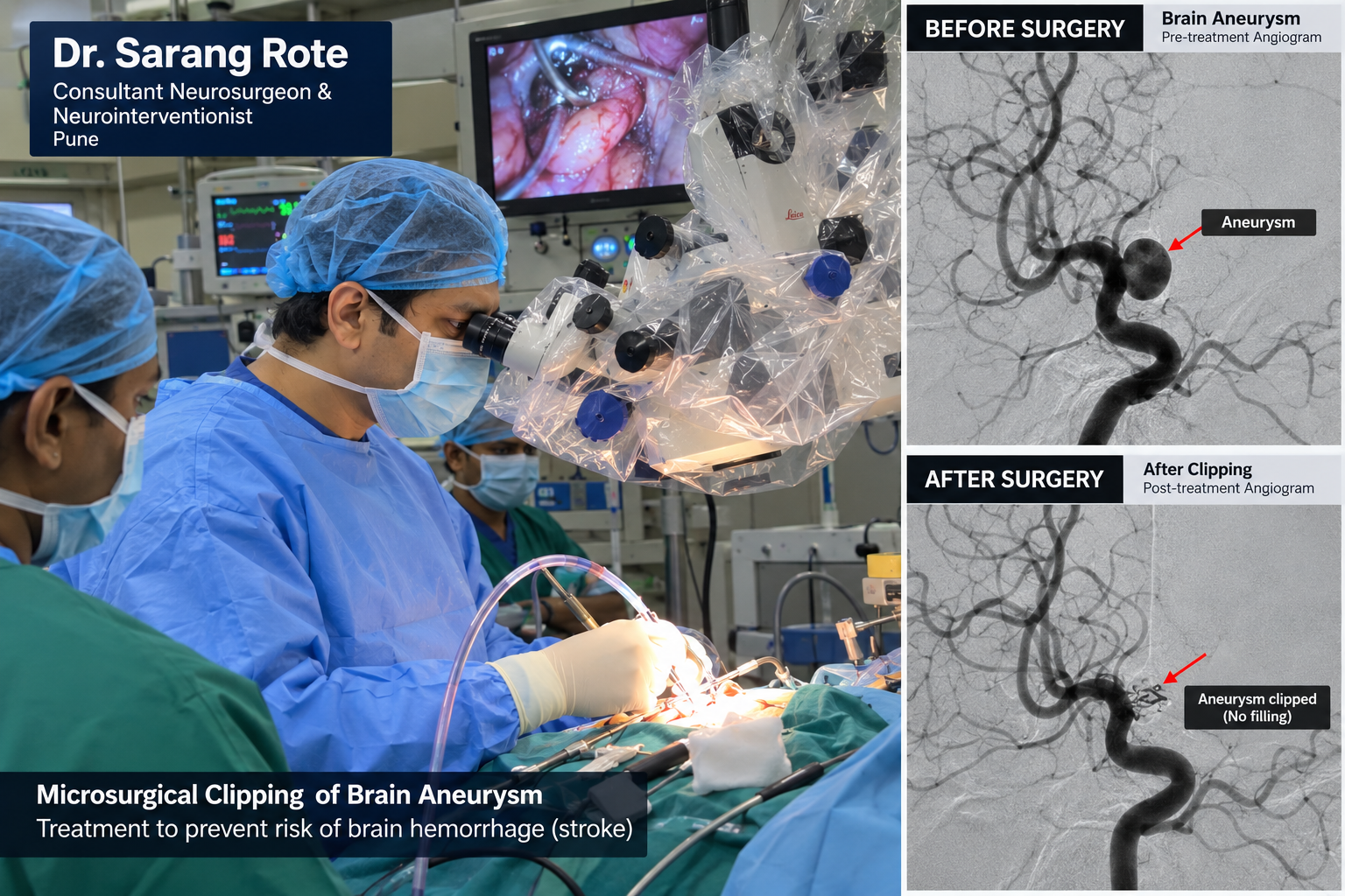 Microsurgical Clipping of Brain Aneurysm in Pune by Dr. Sarang Rote